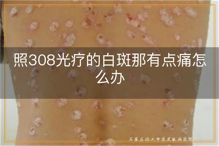 照308光疗的白斑那有点痛怎么办