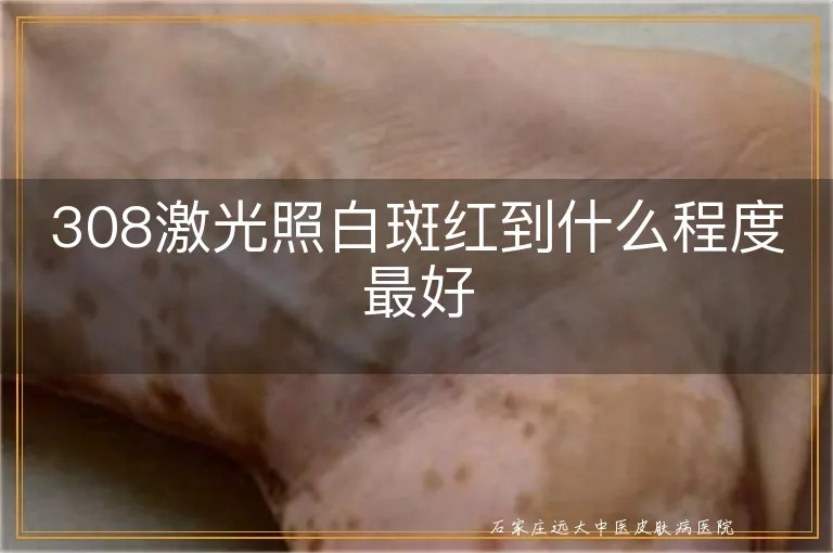 308激光照白斑红到什么程度最好