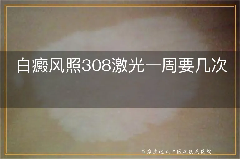 白癜风照308激光一周要几次