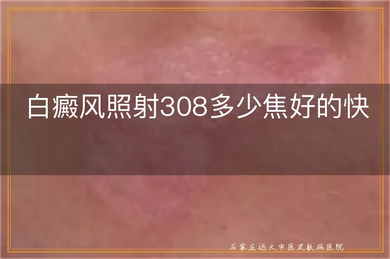 白癜风照射308多少焦好的快