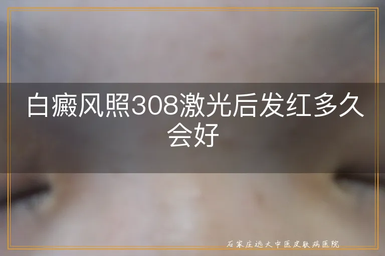 白癜风照308激光后发红多久会好