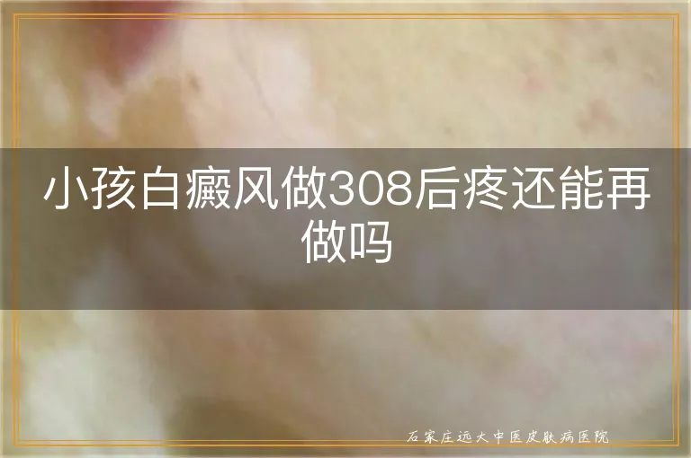 小孩白癜风做308后疼还能再做吗