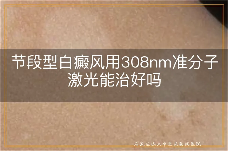 节段型白癜风用308nm准分子激光能治好吗