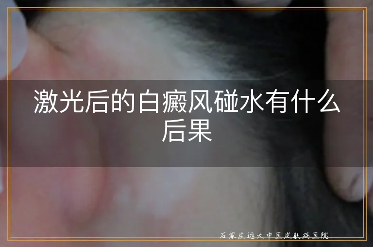 激光后的白癜风碰水有什么后果