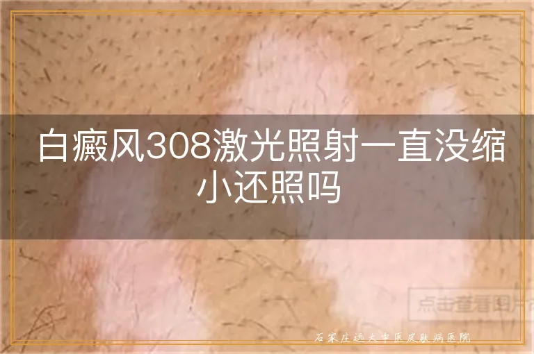 白癜风308激光照射一直没缩小还照吗