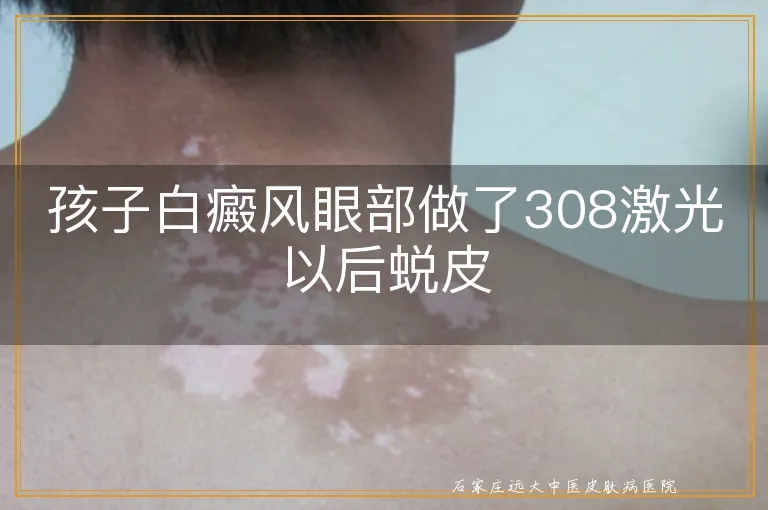 孩子白癜风眼部做了308激光以后蜕皮