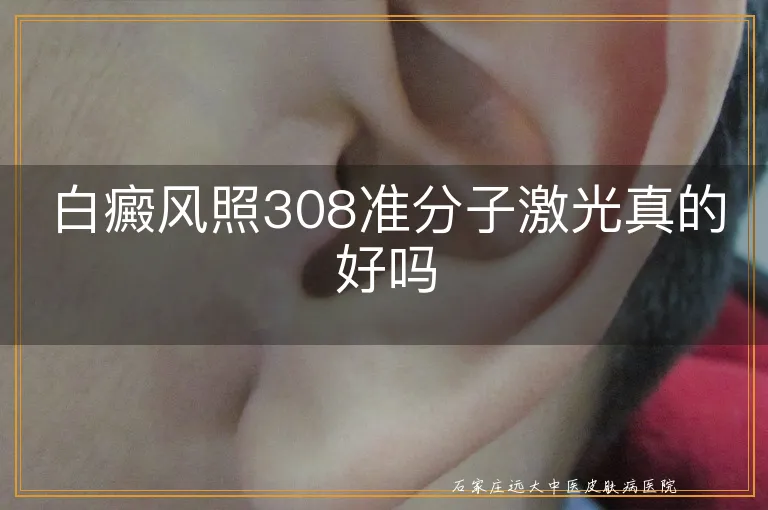 白癜风照308准分子激光真的好吗