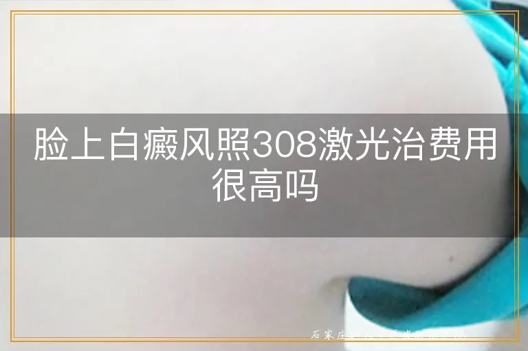 脸上白癜风照308激光治费用很高吗