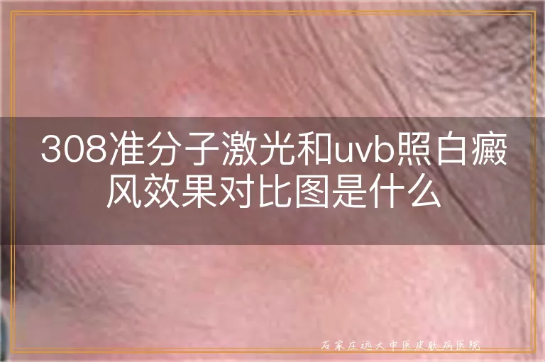 308准分子激光和uvb照白癜风效果对比图是什么