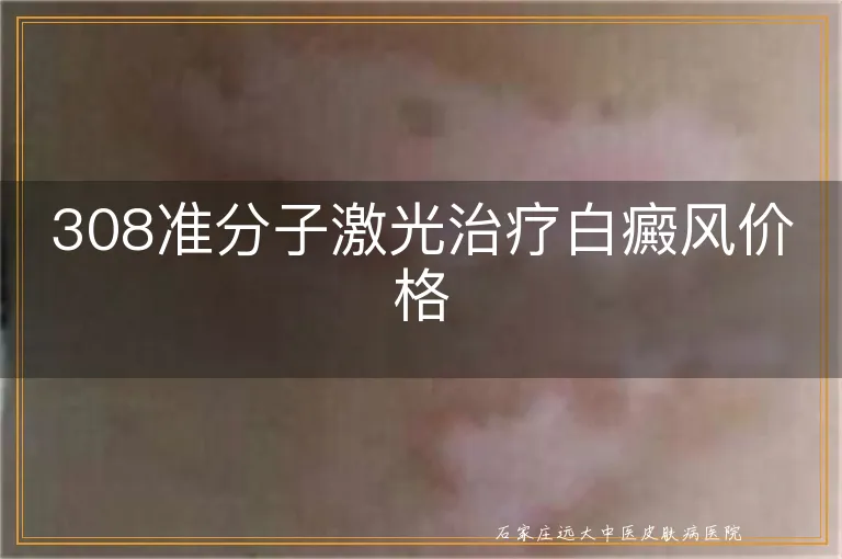 308准分子激光治疗白癜风价格