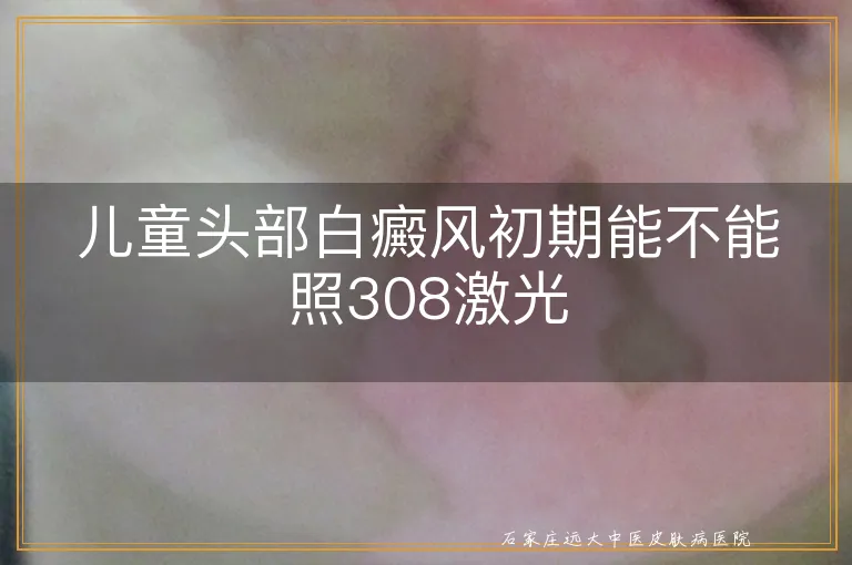 儿童头部白癜风初期能不能照308激光