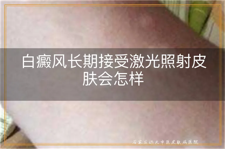 白癜风长期接受激光照射皮肤会怎样