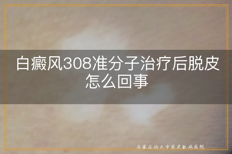 白癜风308准分子治疗后脱皮怎么回事