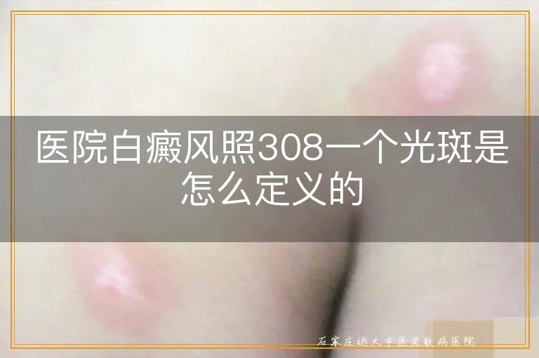 医院白癜风照308一个光斑是怎么定义的