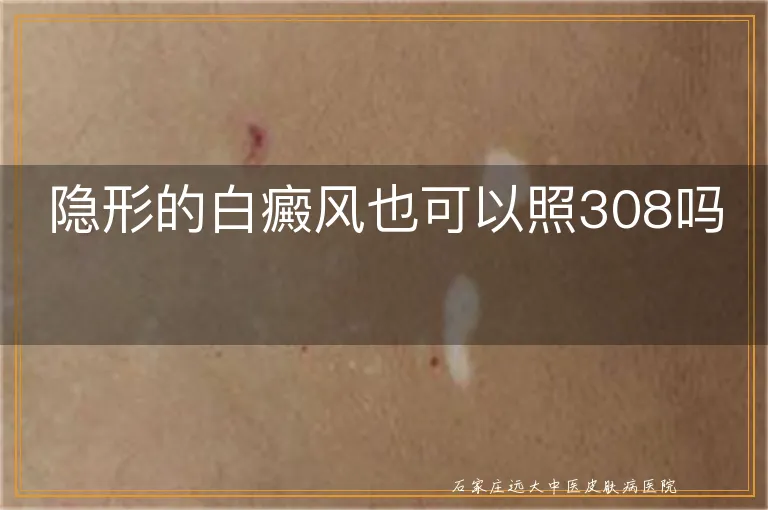 隐形的白癜风也可以照308吗