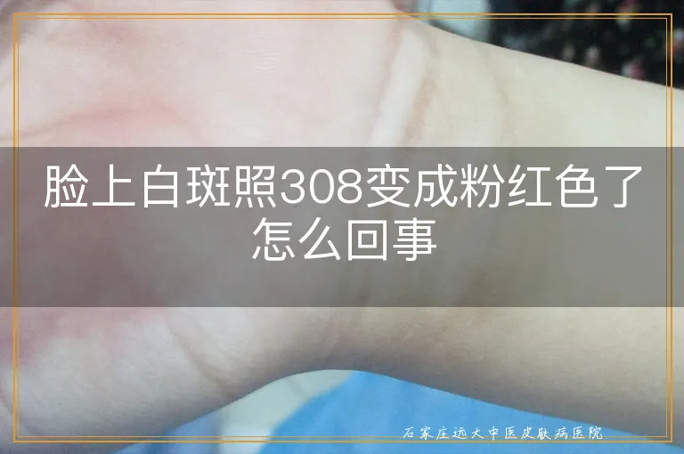 脸上白斑照308变成粉红色了怎么回事