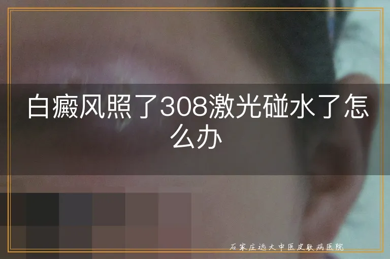 白癜风照了308激光碰水了怎么办