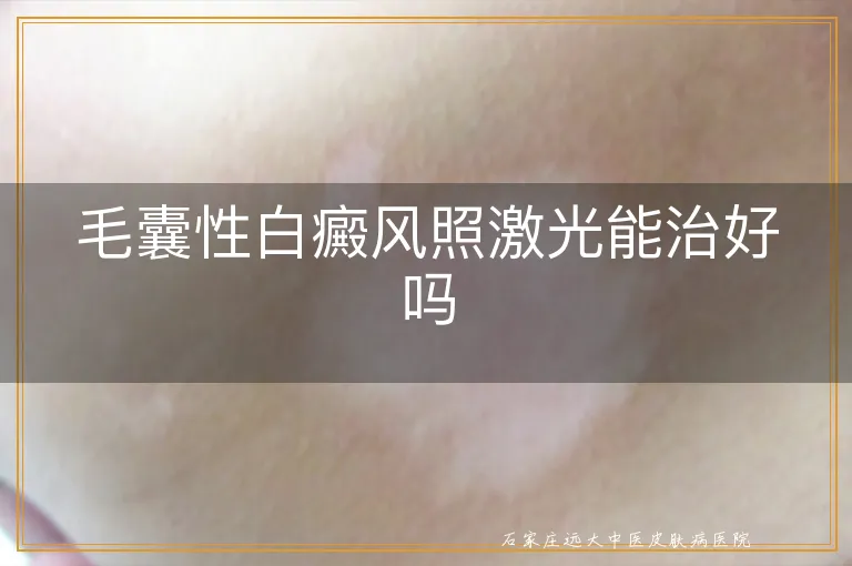 毛囊性白癜风照激光能治好吗