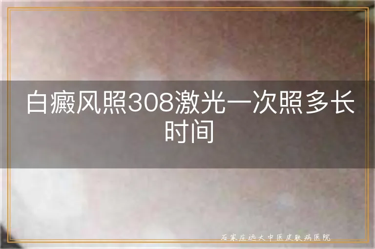 白癜风照308激光一次照多长时间