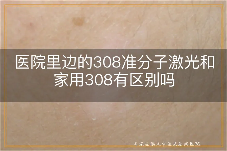 医院里边的308准分子激光和家用308有区别吗