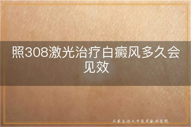 照308激光治疗白癜风多久会见效