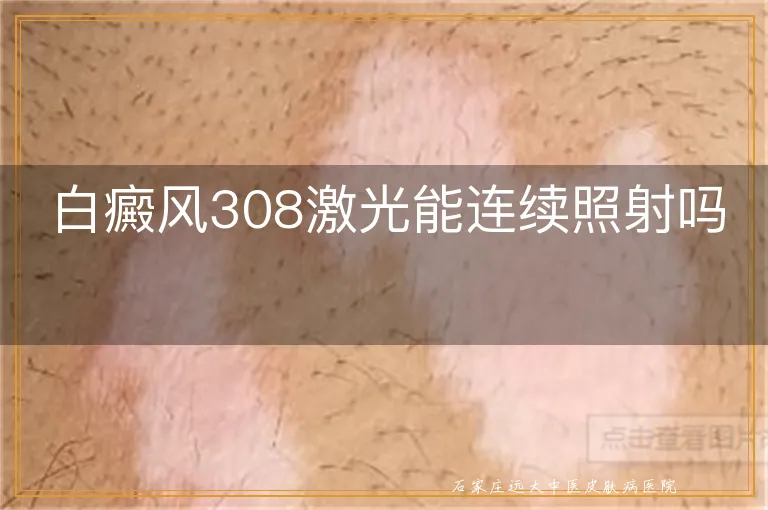 白癜风308激光能连续照射吗