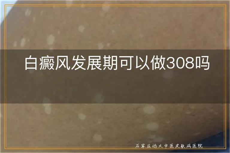 白癜风发展期可以做308吗