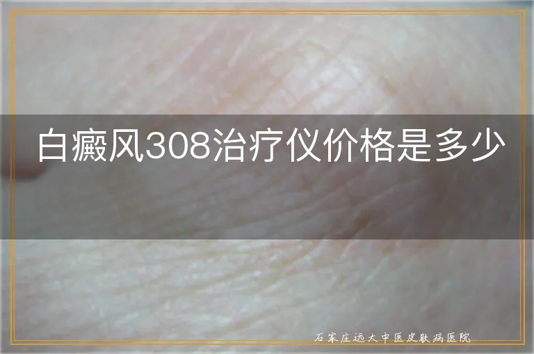 白癜风308治疗仪价格是多少