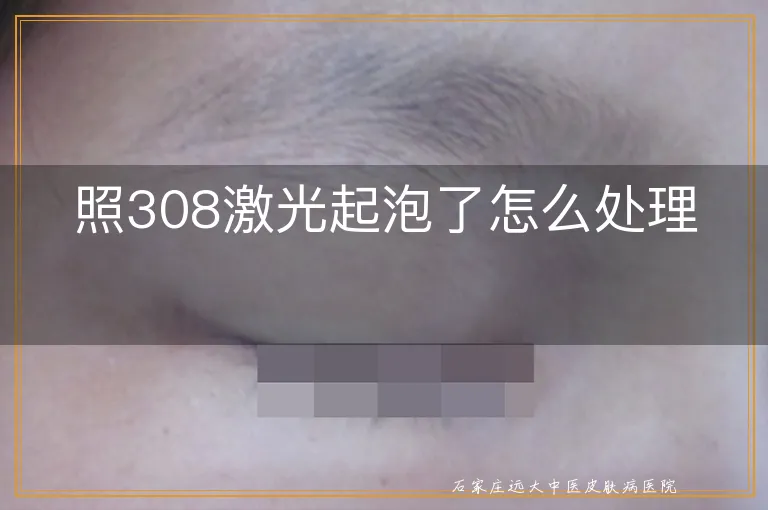 照308激光起泡了怎么处理