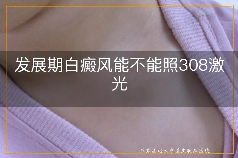 发展期白癜风能不能照308激光