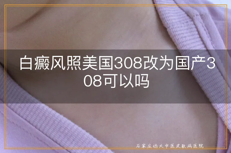 白癜风照美国308改为国产308可以吗