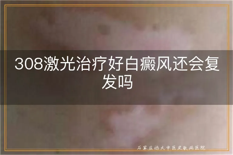 308激光治疗好白癜风还会复发吗