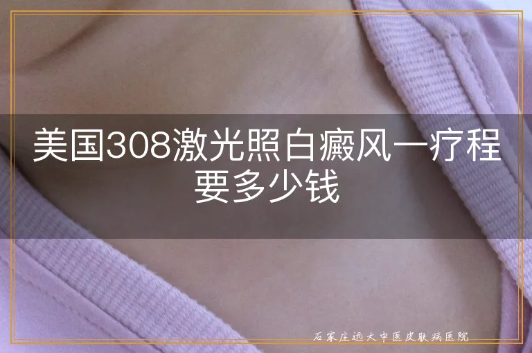 美国308激光照白癜风一疗程要多少钱