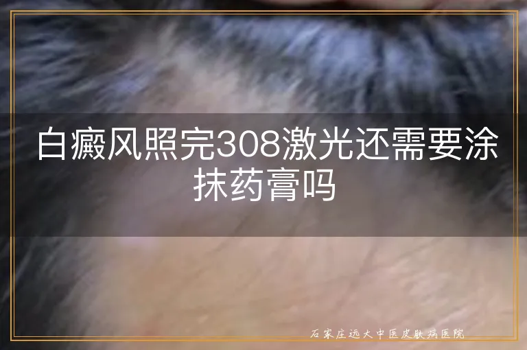 白癜风照完308激光还需要涂抹药膏吗