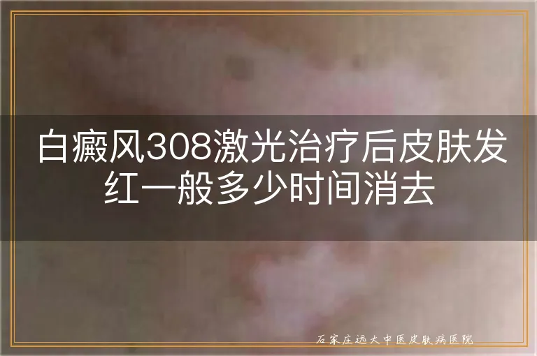 白癜风308激光治疗后皮肤发红一般多少时间消去