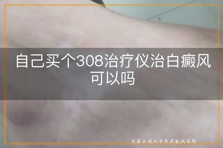 自己买个308治疗仪治白癜风可以吗