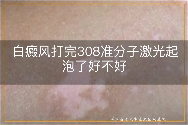 白癜风打完308准分子激光起泡了好不好