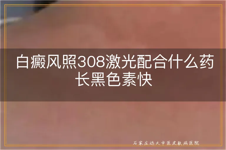 白癜风照308激光配合什么药长黑色素快