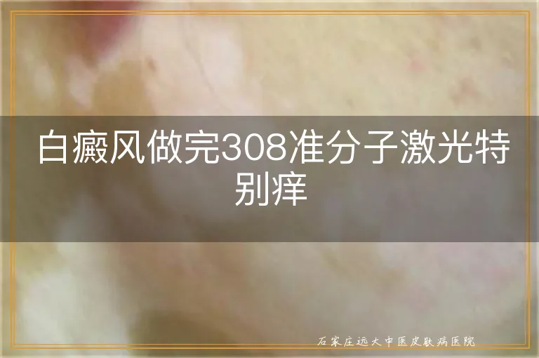 白癜风做完308准分子激光特别痒