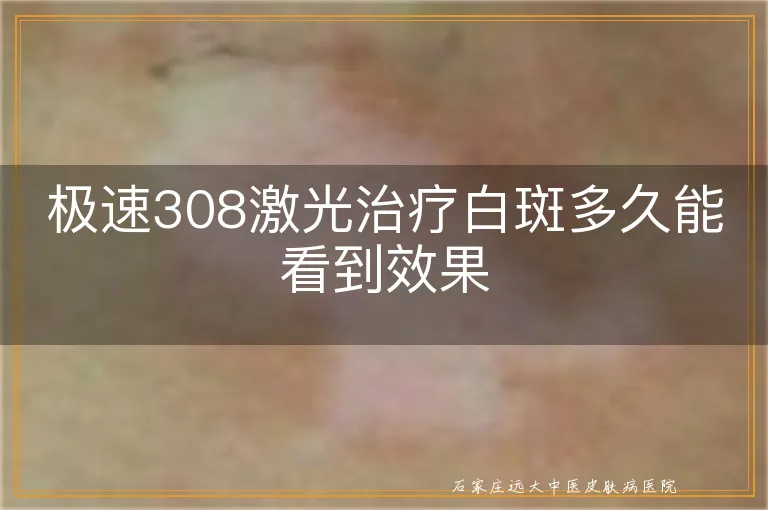 极速308激光治疗白斑多久能看到效果