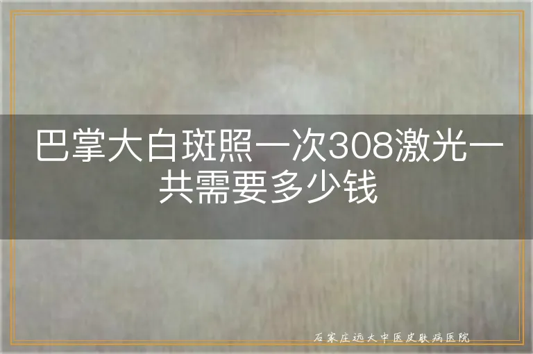 巴掌大白斑照一次308激光一共需要多少钱