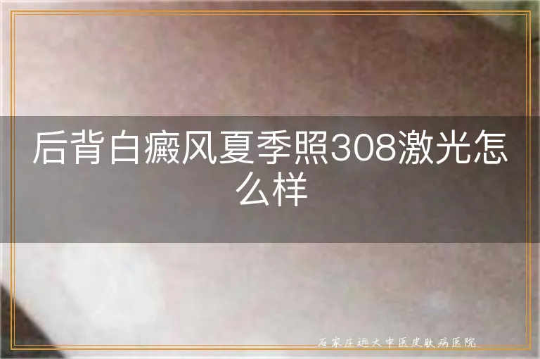 后背白癜风夏季照308激光怎么样