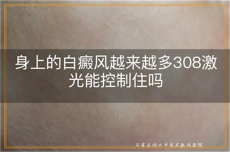 身上的白癜风越来越多308激光能控制住吗