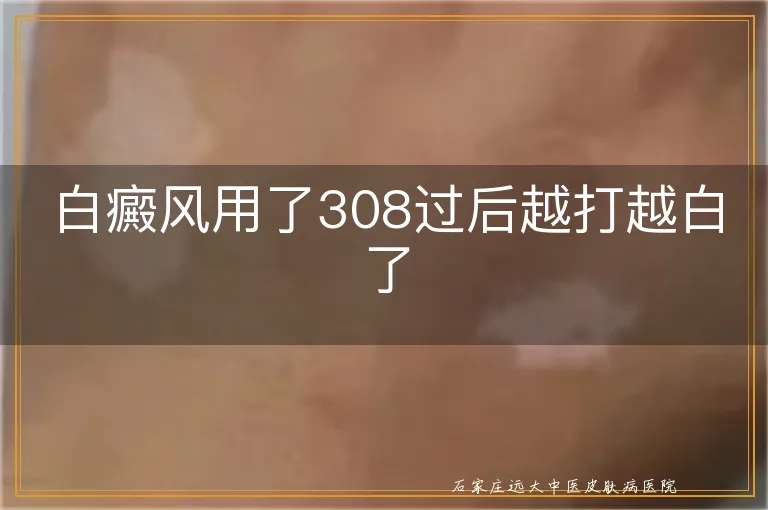 白癜风用了308过后越打越白了