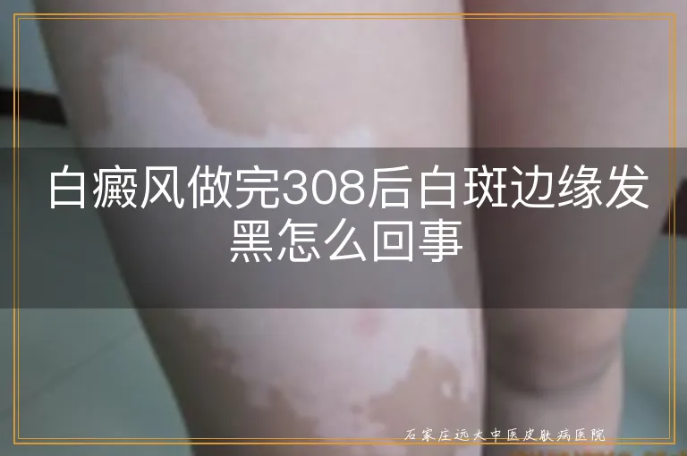 白癜风做完308后白斑边缘发黑怎么回事