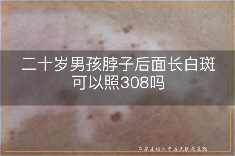 二十岁男孩脖子后面长白斑可以照308吗