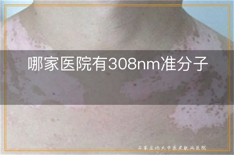 哪家医院有308nm准分子