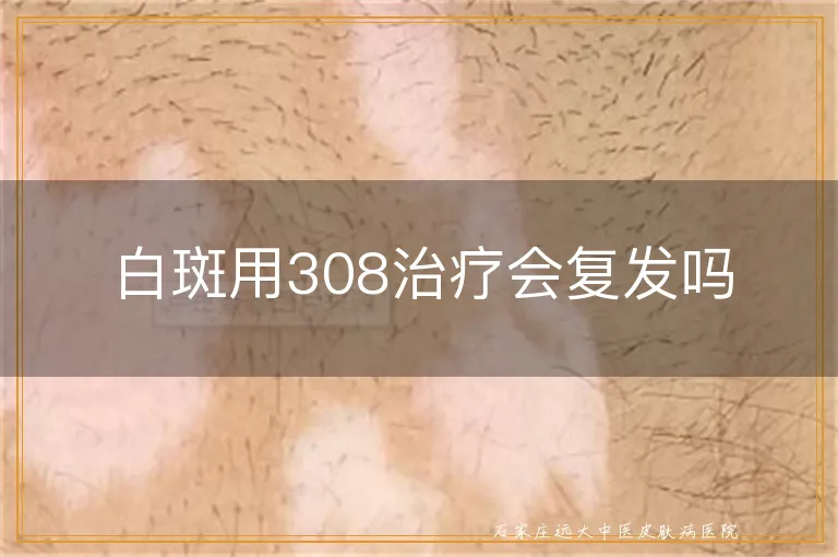 白斑用308治疗会复发吗