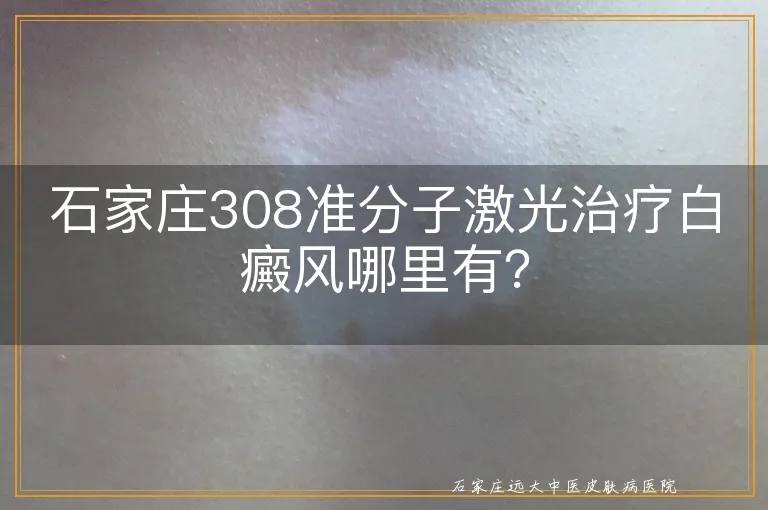 石家庄308准分子激光治疗白癜风哪里有？