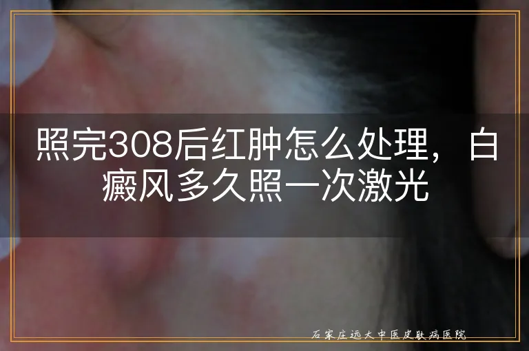 照完308后红肿怎么处理，白癜风多久照一次激光